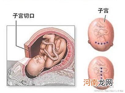 刨腹产二胎的的过程