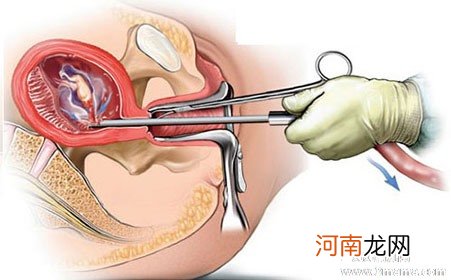 多次流产会使我不孕吗