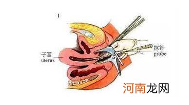 全过程图 节育环怎么取