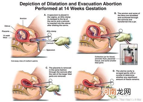 无痛人流真的不痛吗