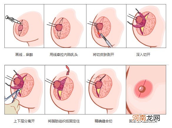 乳头挤出黄水是怎么了