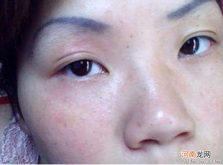 化妆品为什么会导致皮肤过敏