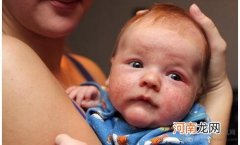婴儿湿疹常见的十三种误区