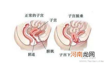 顺产怎么防止子宫下垂