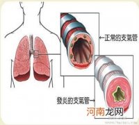 慢性支气管炎的八大诱因