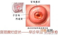 被过度治疗的宫颈“糜烂”