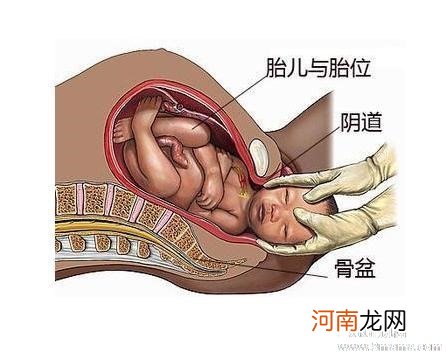 胎儿脸朝外能顺产吗