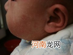宝宝皮肤过敏的原因