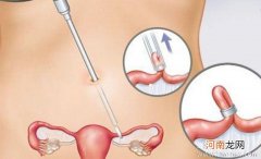 输卵管结扎手术的四种方法
