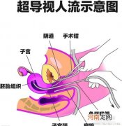 第一次人流该注意什么？