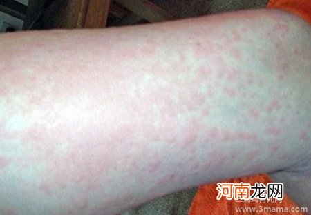 脸皮肤过敏疾病是怎么引起的