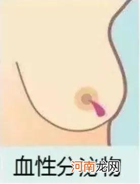 乳头内陷是什么原因造成的?