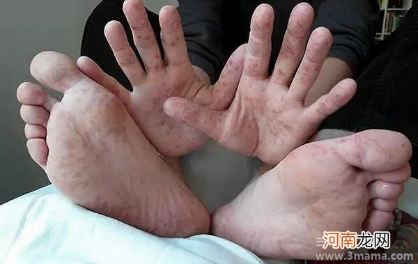 手足口病的症状都是哪些呢