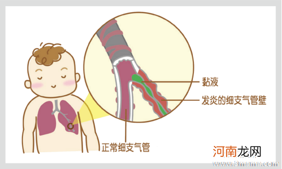 小儿支气管哮喘的护理方法有哪些？