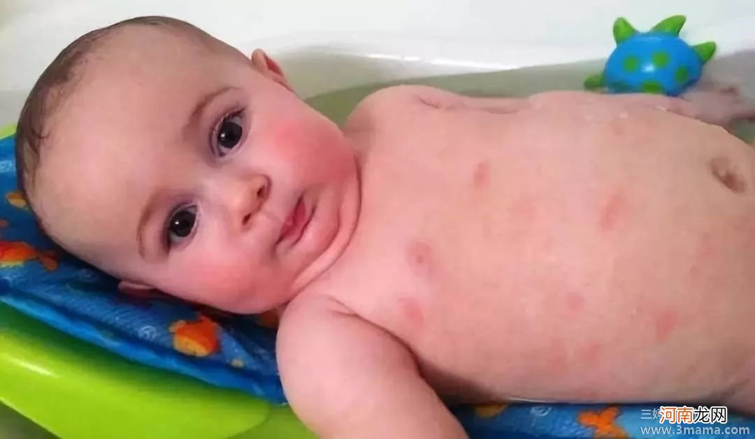 宝宝湿疹要远离5种过敏食物