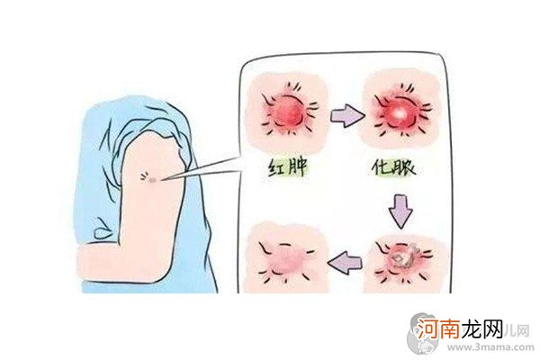 卡介疫苗接种没有疤痕要重打吗 看看疫苗规定就懂了