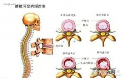 得了腰间盘突出怎么办