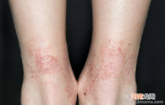 皮肤过敏瘙痒怎么办？