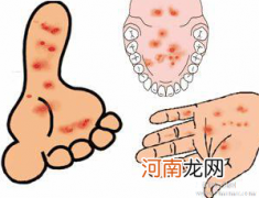 手足口病的形成原因是什么?