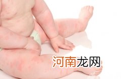 宝宝过敏如何是好