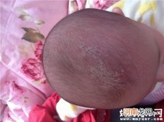 宝宝这么小为什么会有头垢 去除宝宝头垢按摩油能行吗