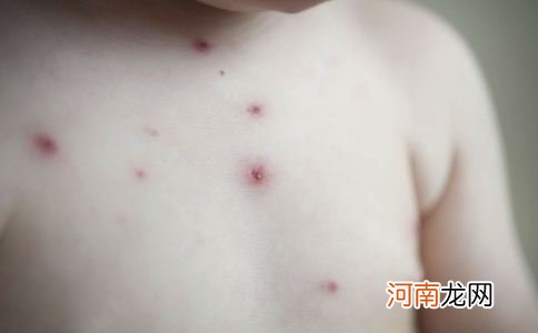 冬季水痘高发 小儿该怎么预防水痘