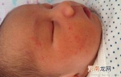 小儿过敏性湿疹怎么办？如何护理？