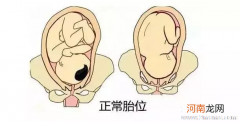 胎位太高可以顺产吗