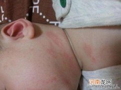 宝宝母乳过敏症状有哪些