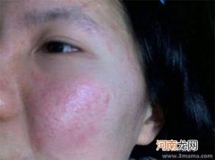 引起脸部皮肤过敏的原因是什么
