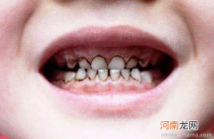 小儿牙齿保健的熟习误区