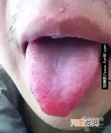 舌头上有红点怎么办