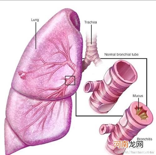 婴儿支气管炎有哪些症状