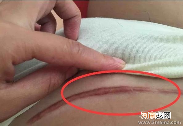 顺产侧切和剖腹产哪个好