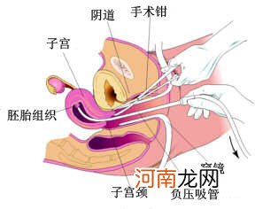 人流吸宫手术能吸干净不