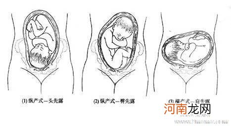 胎方位rop能顺产吗