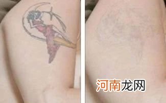 去纹身一般多少钱