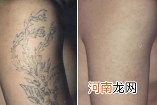 去纹身一般多少钱