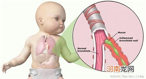 小儿支气管炎的治疗方法有啥？