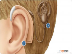 人工耳蜗并非植入越早越好