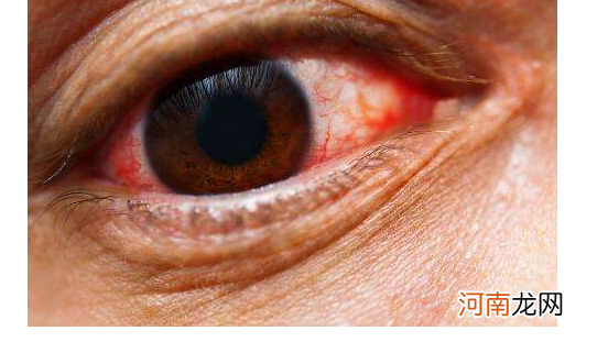 白眼球发蓝暗示着缺铁性贫血比较严重，双眼4个病症，你中好多个？