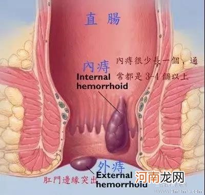 顺产后有痔疮怎么办