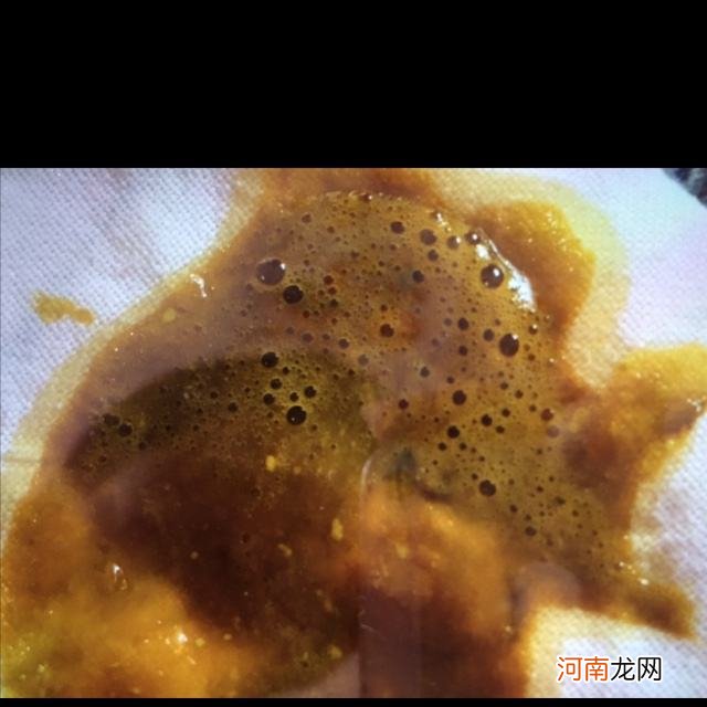 包含拉黑粑粑是什么原因啊的词条