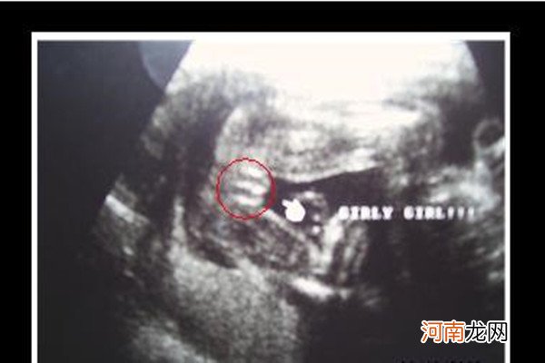 孕15周胎儿小鸡彩超图