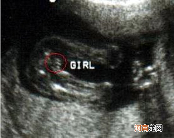 孕15周胎儿小鸡彩超图