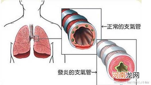 引起支气管炎的病因是什么