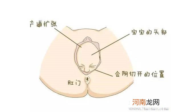 顺产分娩：为什么一定要做会阴侧切呢？ - 顺产