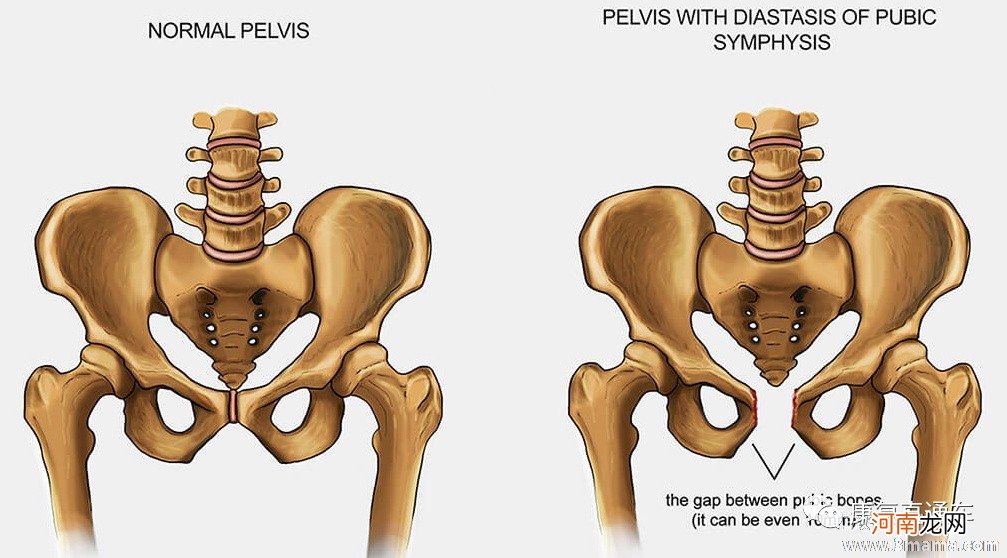 顺产后耻骨分离的症状