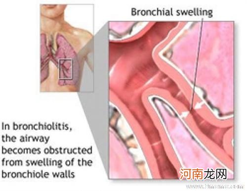 偏方治疗小儿支气管炎