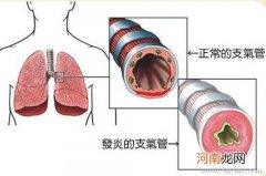 儿童支气管哮喘形成的原因